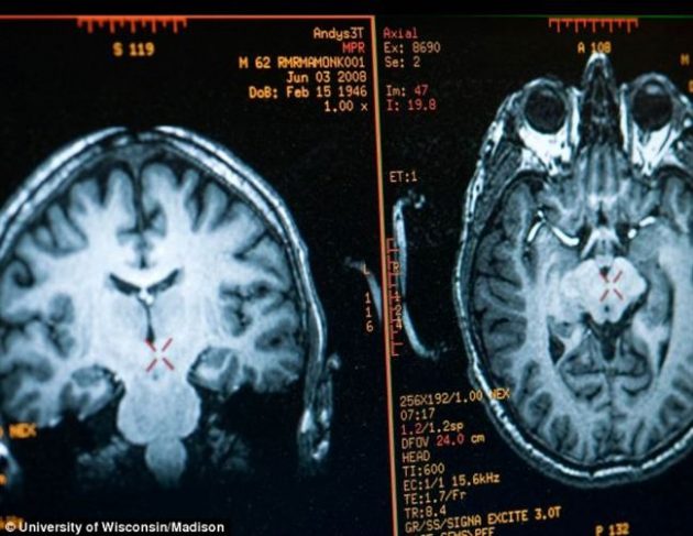 Изображение головного мозга Матье Рикара, полученное при МРТ