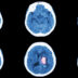 6 признаков инсульта, при которых нужно действовать как можно быстрее