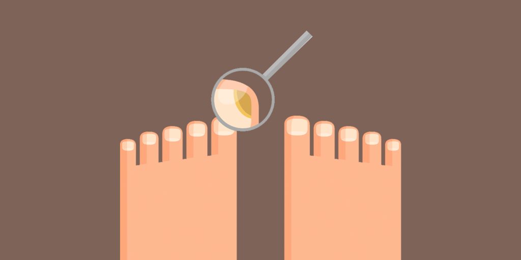 Грибок ногтей как долго лечить — Сайт о грибке ногтя