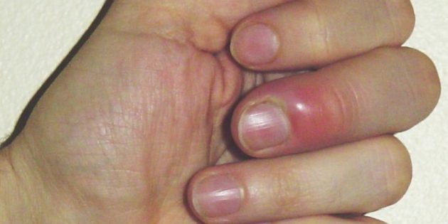 Как лечить заусенцы на пальцах