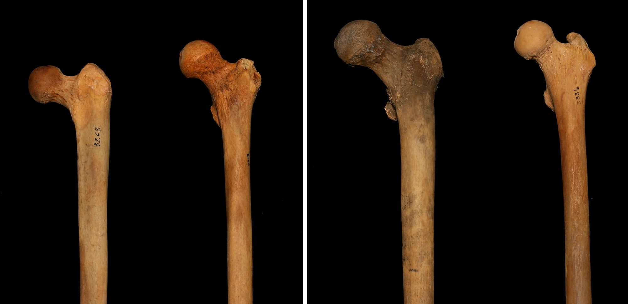 Ковид кости. Трубчатая бедренная кость. Бедренная кость шейка. Шейка бедренной кости анатомия. Бедернна кость анатомиякость.