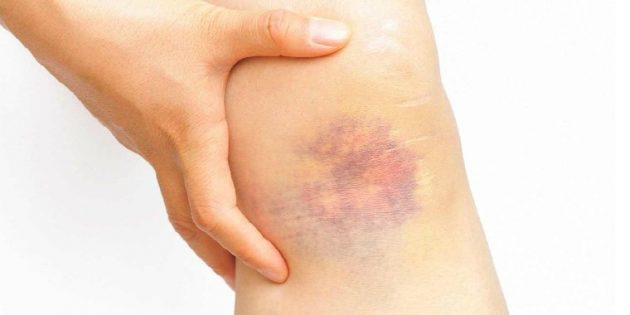 How to quickly remove the bruise: only scientific methods