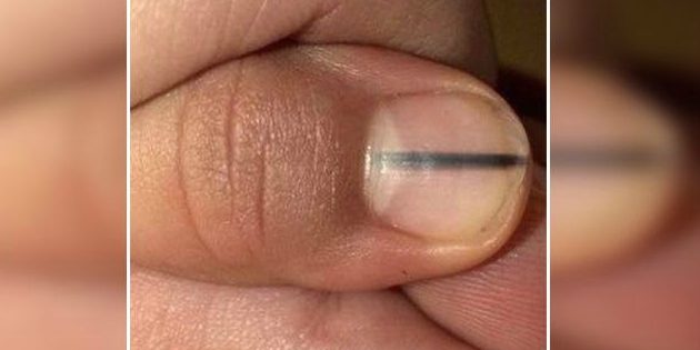 О каких болезнях говорят ногти на руках фото thumbnail