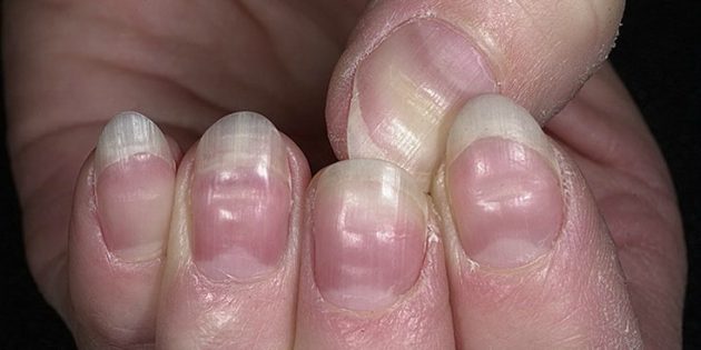 Как определить болезнь по ногтям фото и описание thumbnail