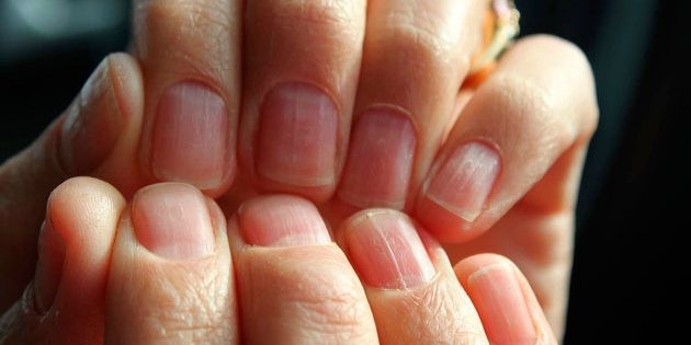 Какие болезни можно распознать по ногтям thumbnail