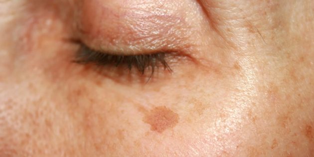 Why Age Spots Appear And How To Get Rid Of Them