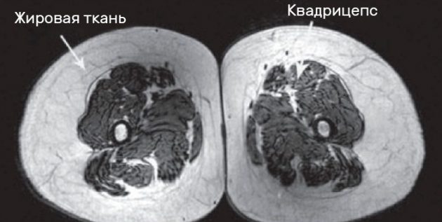 Квадрицепсы