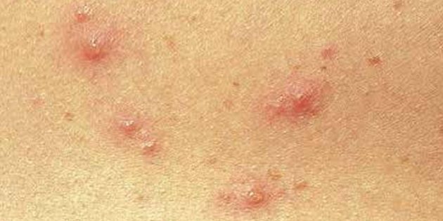 Chickenpox in children and adults: how not to get sick and how to be treated