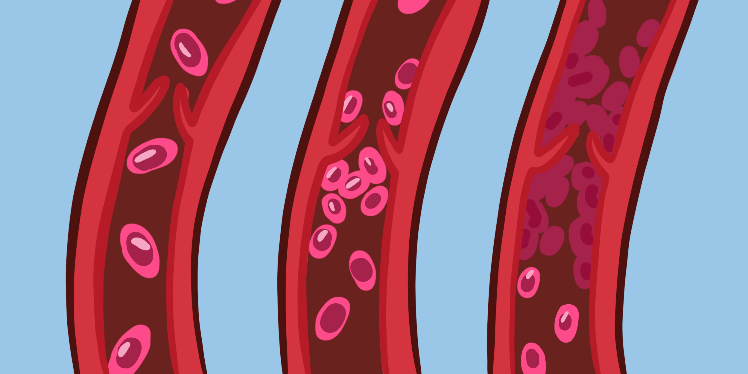 Что такое тромбоз и как его предотвратить