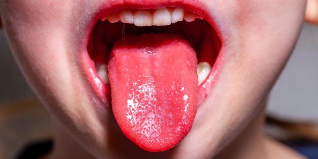 Симптомы скарлатины: «клубничный» язык
