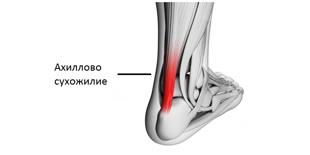 Ахиллесово сухожилие болит при ходьбе лечение картинки