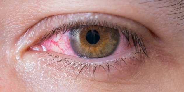 Conjunctivitis: Why blush eyes and how to treat them