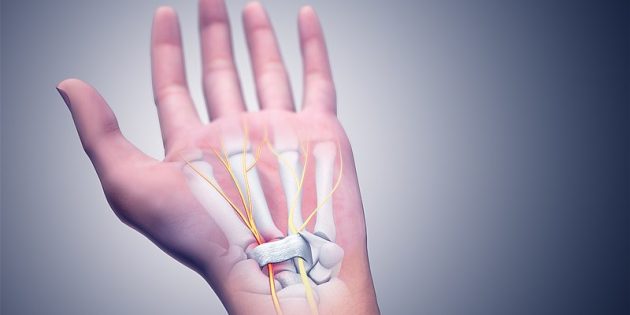 Синдром карпального канала запястья руки лечение thumbnail