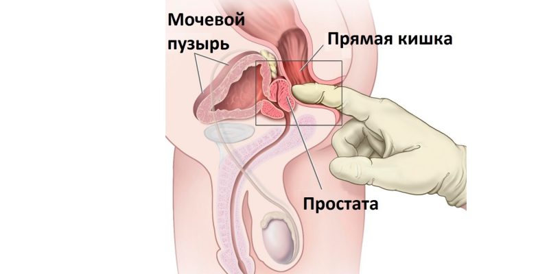 Массаж простаты: все, что ты хотела (и не хотела) о нем знать Массаж простаты: все, что ты хотела (и не хотела) о нем знать