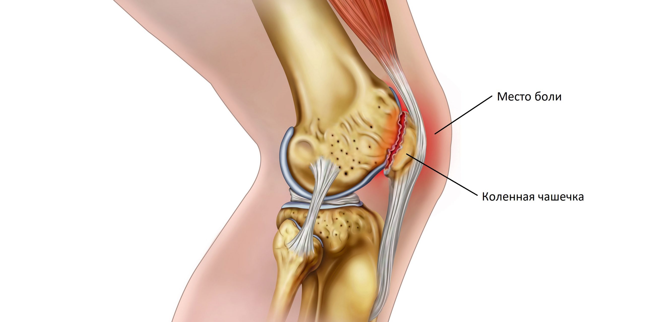 bol u koljenu gori zglobovi nogu boli bol ispod koljena
