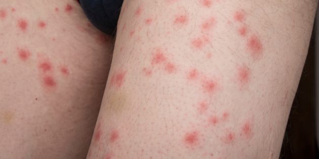Rash on the body: insect bites