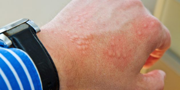 Body rash: contact dermatitis