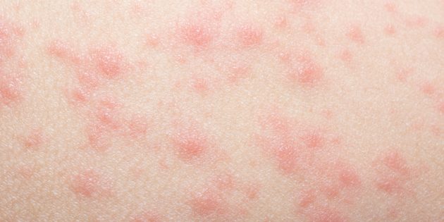Skin rash due to drug allergy