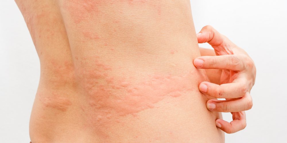 Причины появления аллергической сыпи
