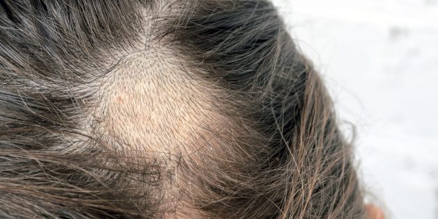 Алопеция: почему вы теряете волосы и как это лечить - Лайфхакер