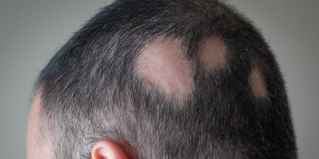 Как называется болезнь при которой не растут волосы thumbnail