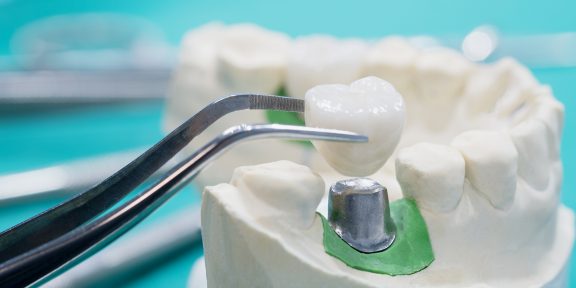 Что нужно знать о зубных коронках