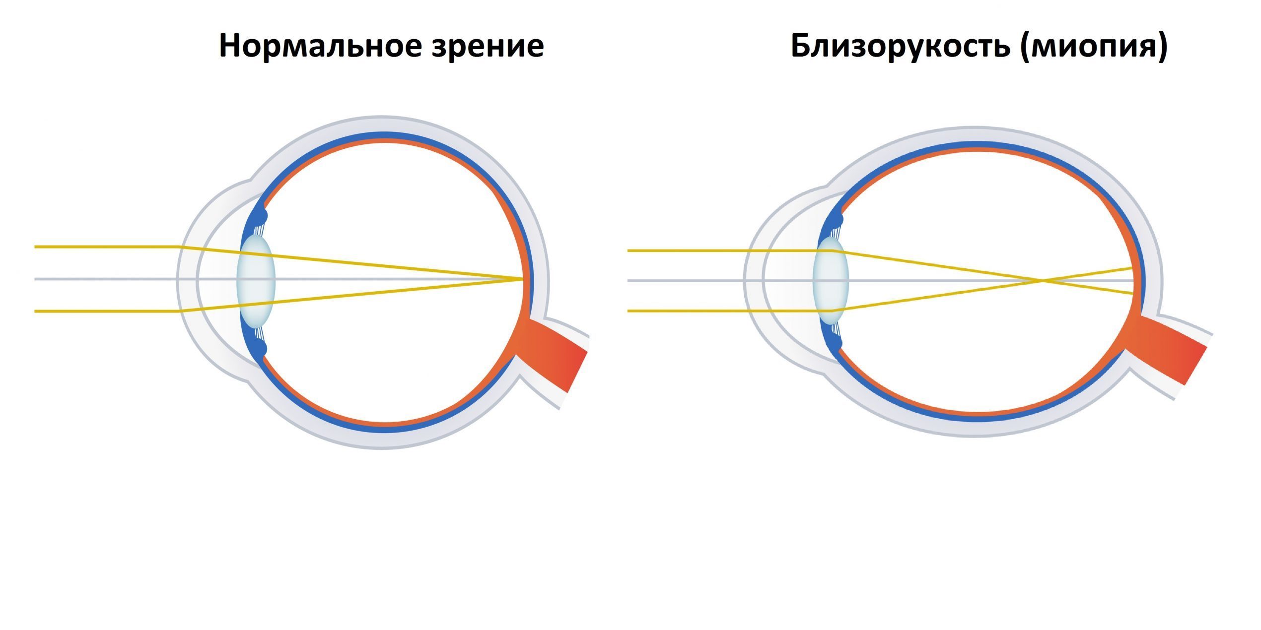 Фокусировка глаза человека. Осевая и рефракционная миопия. Близорукость миопия. Зрение при близорукости. Близорукий и дальнозоркий глаз.