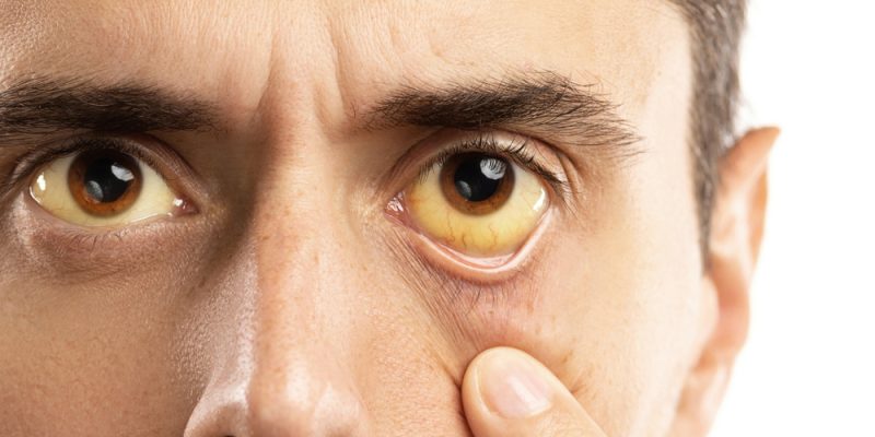 Откуда берётся желтуха и как её лечить — Лайфхакер