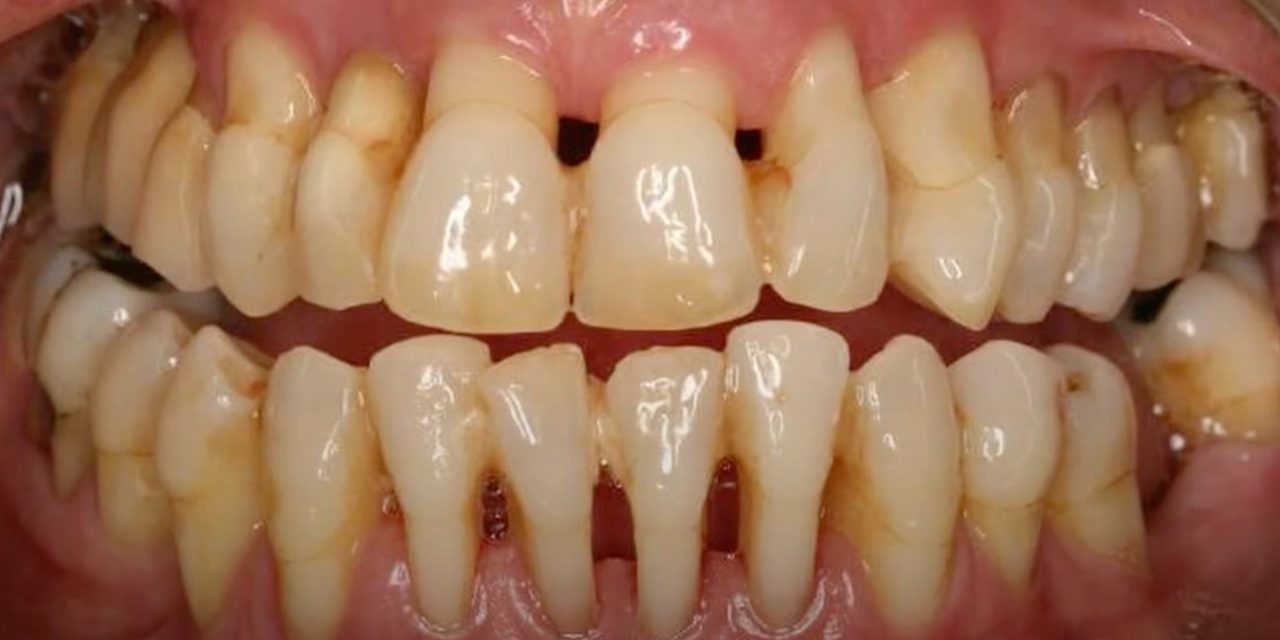 Как вовремя заметить пародонтоз и не потерять зубы - Лайфхакер