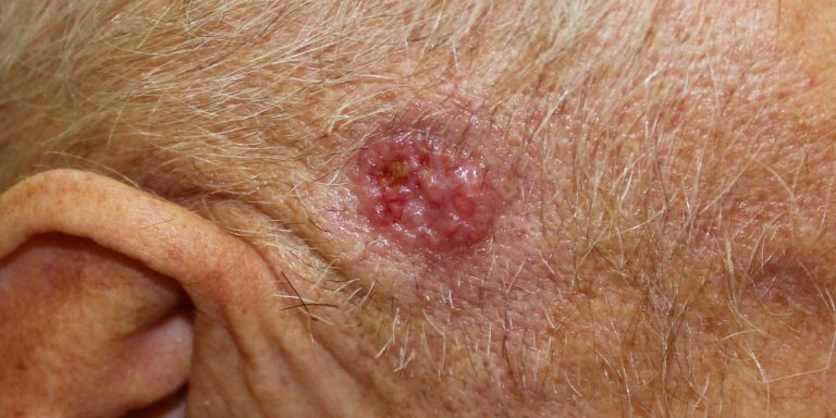 Что такое базалиома и насколько она опасна — Лайфхакер