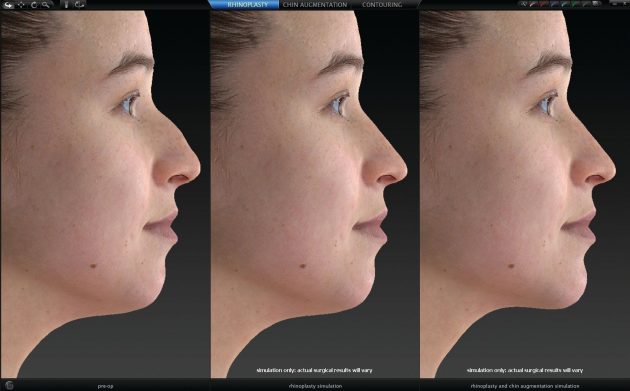 Современная пластическая хирургия: специальной программе пациент может «примерить» новый нос