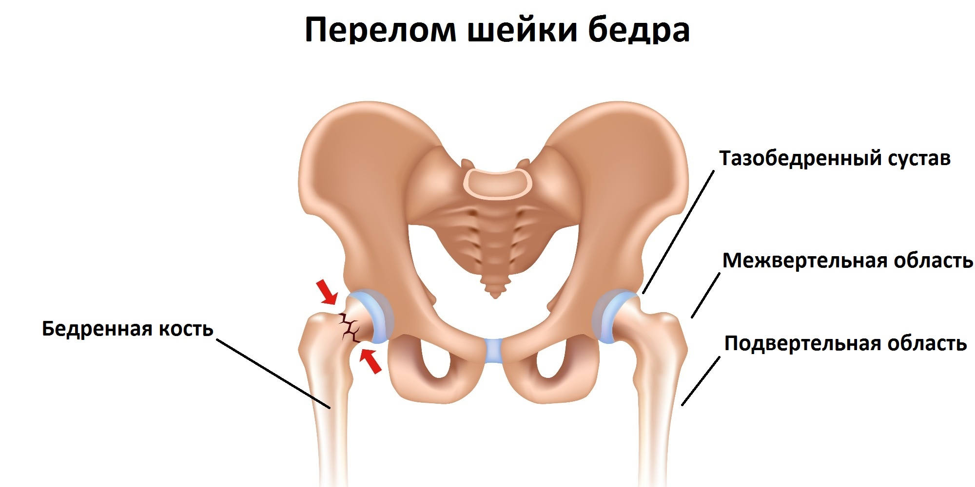 Шейка правого бедра. Шейка тазобедренного сустава перелом. Перелом тазобедренного сустава и кости. Шейка бедра у человека перелом. Перелом шейки тазовой кости.