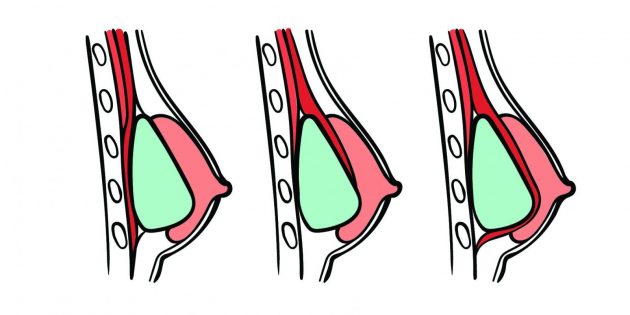Современная пластическая хирургия: имплантат может быть установлен непосредственно под молочную железу или под грудную мышцу