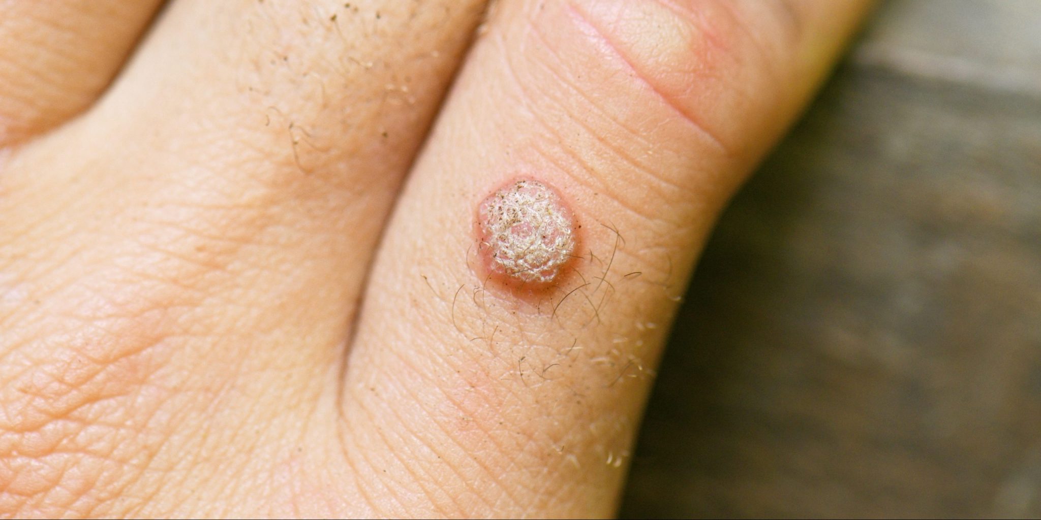 Откуда берутся бородавки и как от них избавиться — Лайфхакер