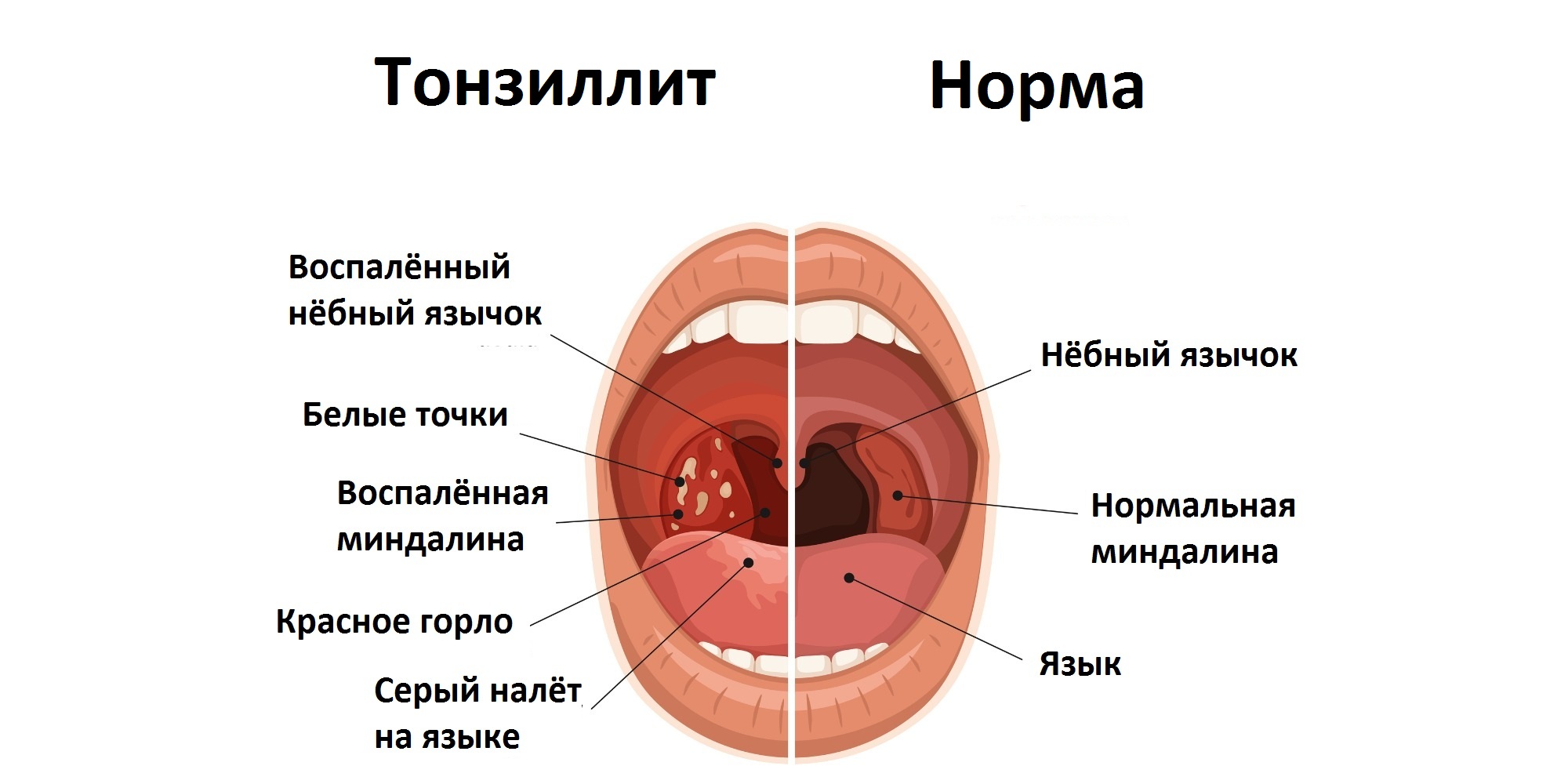 Открой рот видела. Небные миндалины хронический тонзиллит. Клинические симптомы тонзиллит. Хронический тонзиллит вид гланд.