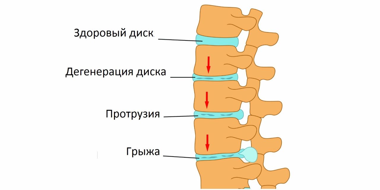 Протрузия межпозвонковых дисков