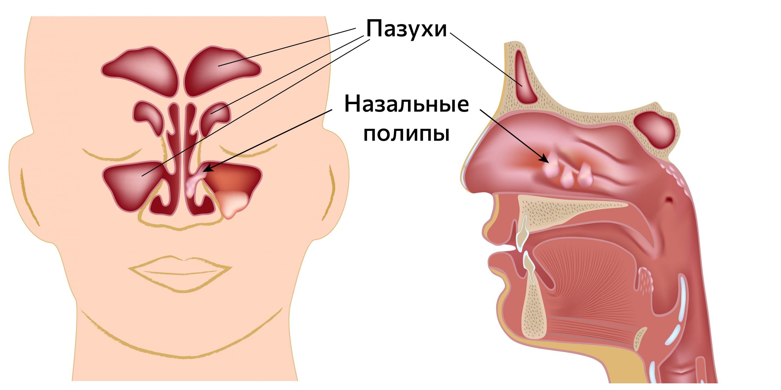 Полипы в носу: симптомы причины, лечение
