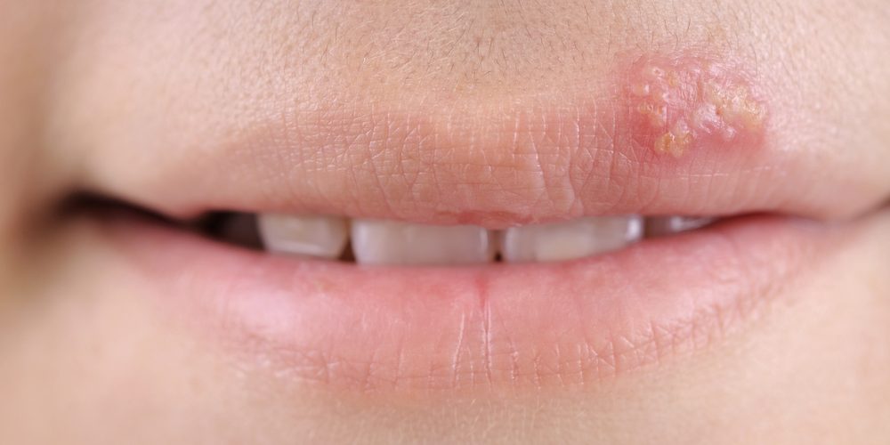 Сама себе лекарь: как быстро вылечить герпес и простуду на губе