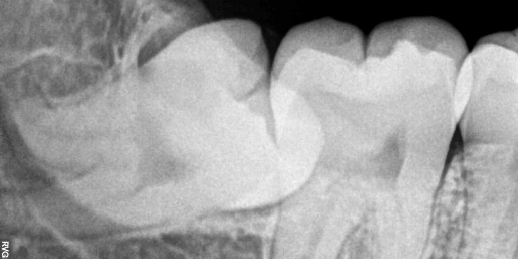 Рентгеновский снимок зуба мудрости 28-летней женщины