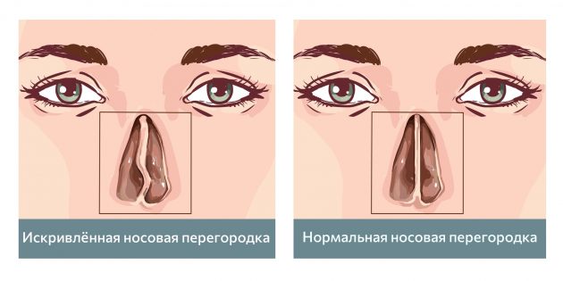 Слева — искривление носовой перегородки, справа — норма