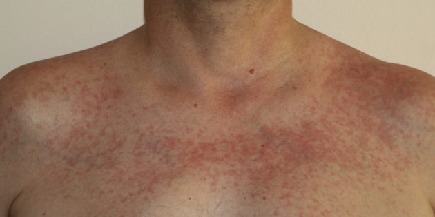 Аллергия на солнце: как проявляется, чем лечить и как защититься детям и взрослым