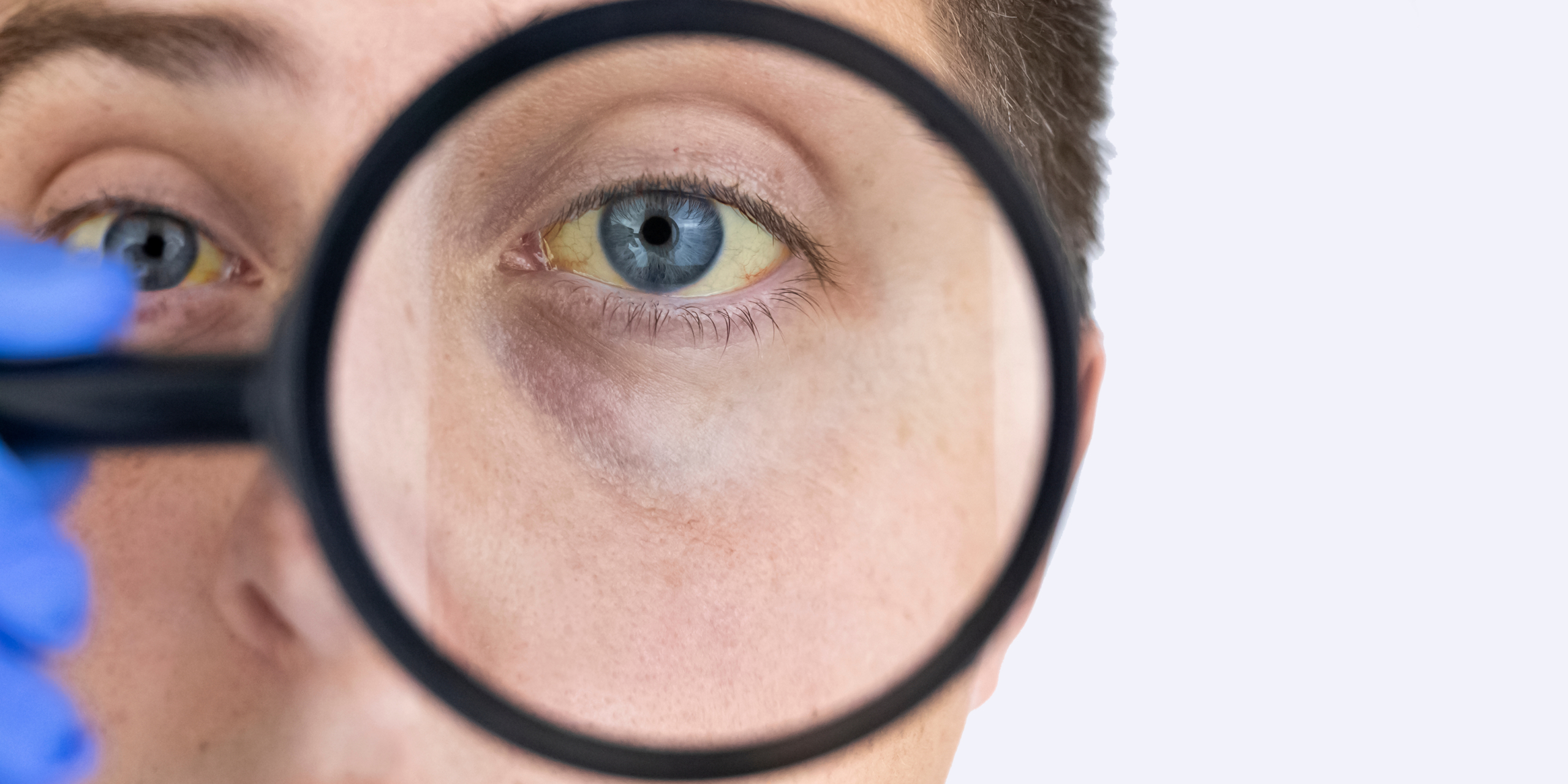 новый гепатит