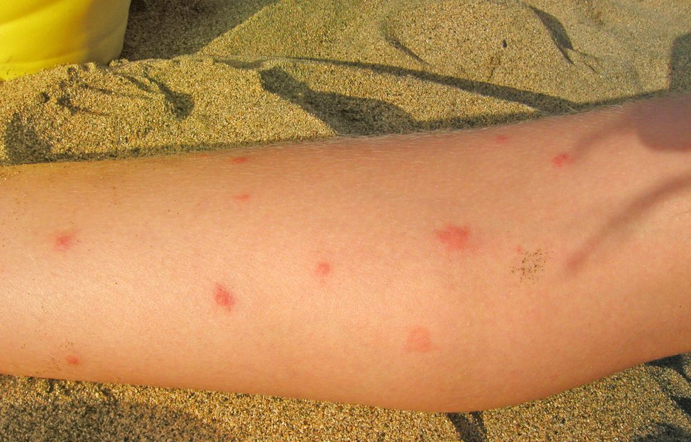 Что делать при укусе комара?