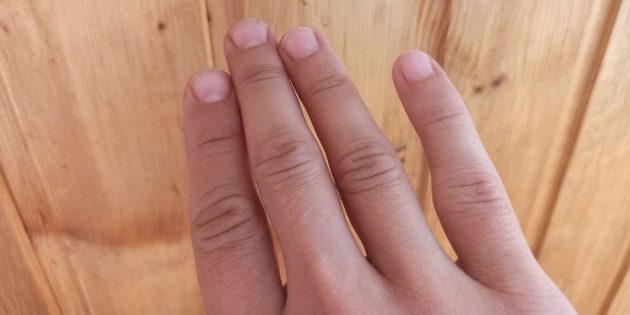 Как понять, что сломан палец: последствия неправильного сращения кости