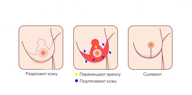Как действительно можно уменьшить грудь с помощью операции