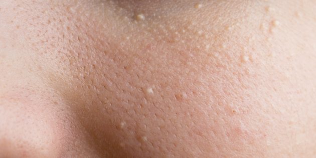 How to remove miliums &#8211; white dots or wen on the face