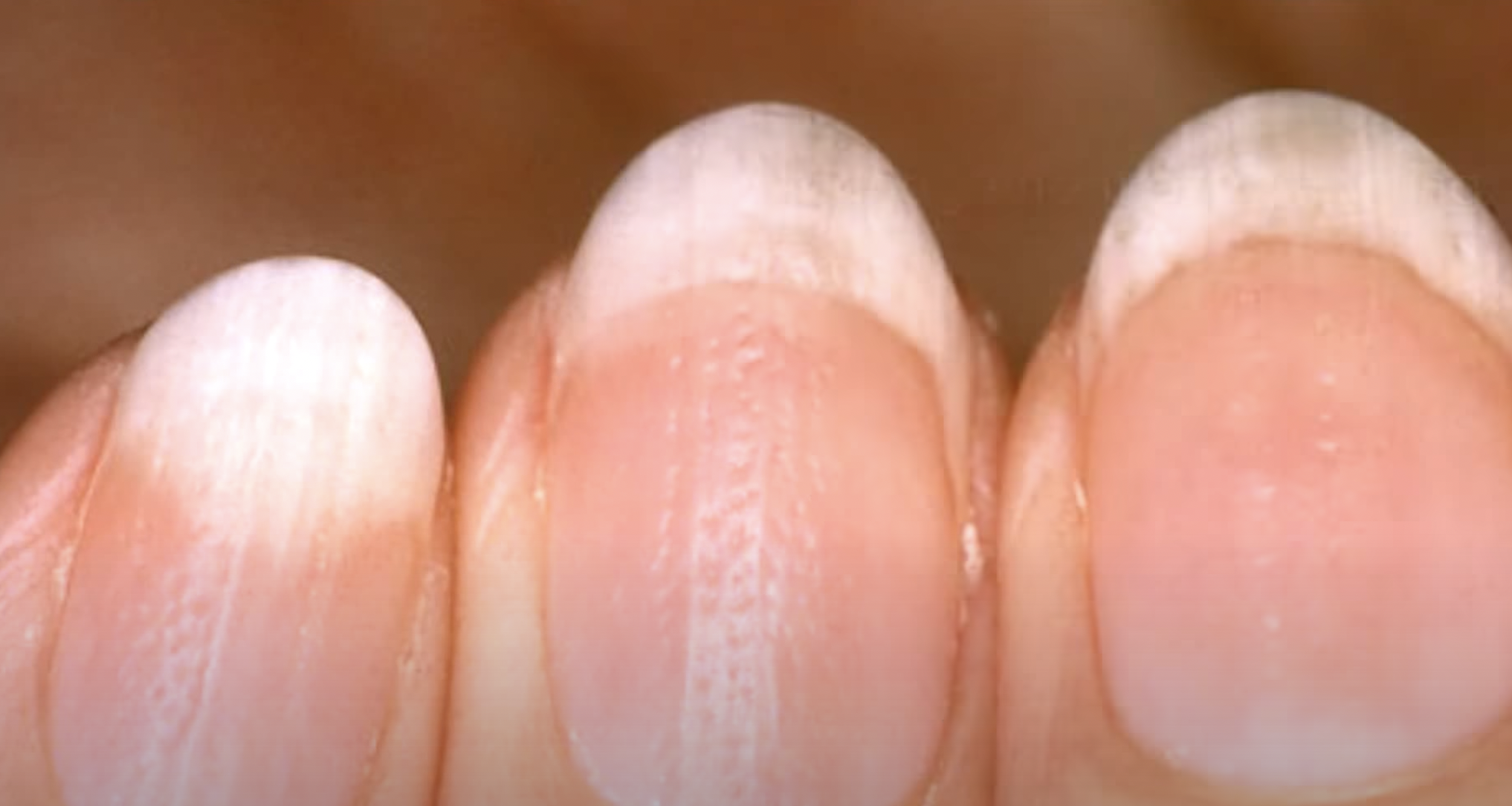 Почему ногти становятся ребристыми вертикально. Микотическая лейконихия. Онихорексис трахионихия. Поперечные борозды бо-Рейли.
