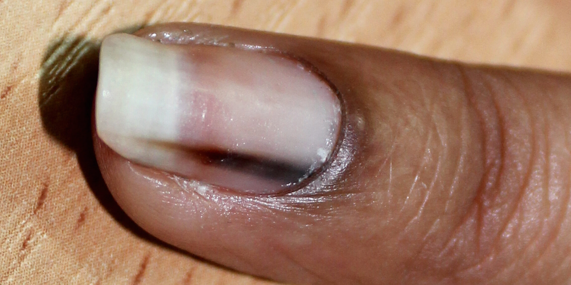 Онихомикоз (грибок ногтей): причины, симптомы и лечение в статье клиники «СОВА»