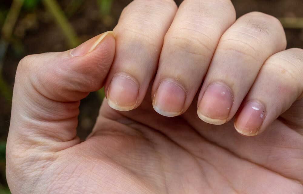 Причины, по которым могут болеть ногти на руках