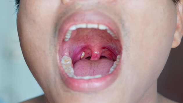 Large plugs in the tonsils